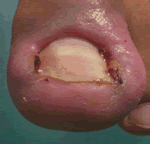 Uña encarnada del Pie Uña enterrada del Pie Onicocriptosis